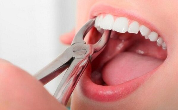 Cách cầm máu khi nhổ răng nhanh chóng hiệu quả an toàn