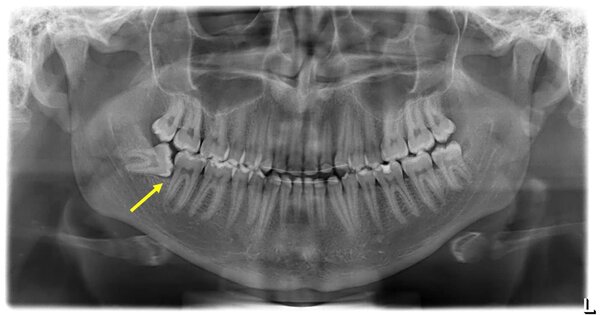 Chụp x-quang trước khi tiến hành nhổ răng