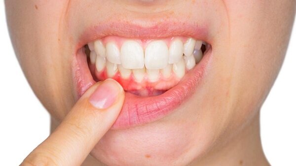 Đây là bệnh lý răng miệng thường gặp