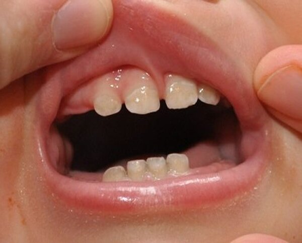 Do các bệnh lý về răng miệng của trẻ em