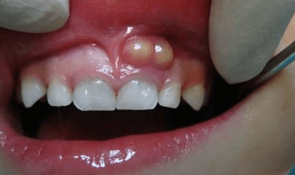 Đau răng và sưng mủ khi bị viêm chân răng