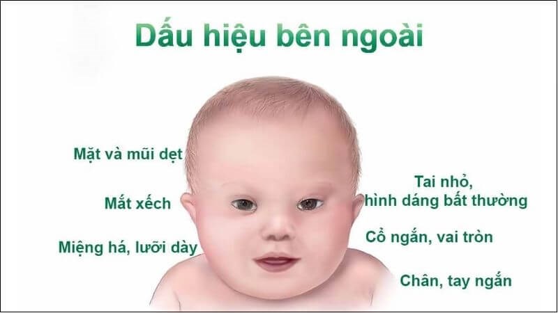 Hội chứng Down ảnh hưởng đến quá trình trẻ chậm mọc răng