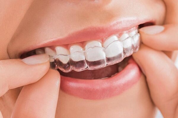 Niềng răng Invisalign có nhiều lợi ích cho người sử dụng.