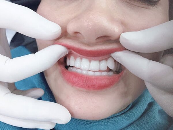Răng khểnh gây nhiều khó khăn trong sinh hoạt hằng ngày.