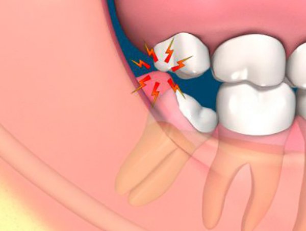 Răng 8 mọc lệch sẽ gây ra nhiều bệnh về răng miệng