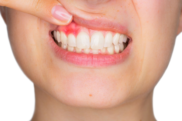 Viêm chân răng có mủ là tình trạng nhiễm trùng xảy ra xung quanh răng hoặc trong tủy răng