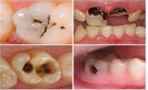 Răng sâu, nứt, hoặc gãy là nguyên nhân cho vi khuẩn xâm nhập gây viêm chân răng có mũ