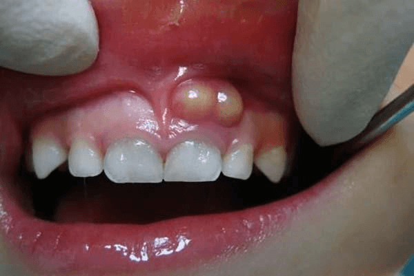 Sưng nướu và mủ là một trong những biểu hiện của viêm chân răng có mủ