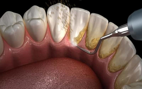 Cạo vôi răng làm sạch khu vực nướu giúp trị viêm nướu