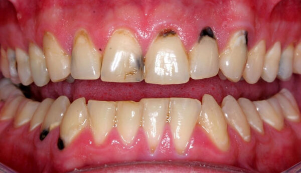 Cần áp dụng các biện pháp nào để ngăn ngừa nướu răng bị đen?
