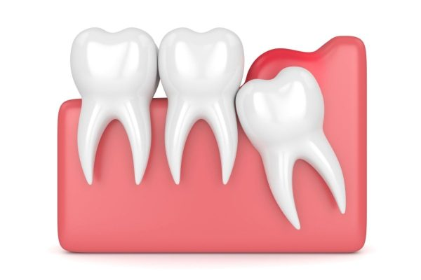 Lợi trùm răng khôn là gì? viêm lợi trùm răng khôn có tự hết không