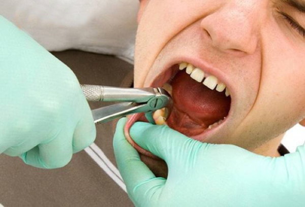 Việc loại bỏ răng khôn kẹp giúp giảm đau đớn và khó chịu