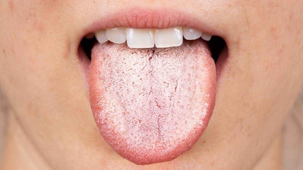 Nhiễm nấm miệng xảy ra khi nấm Candida phát triển quá mức