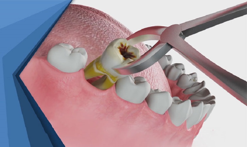 Các trường hợp nào bắt buộc phải nhổ răng?