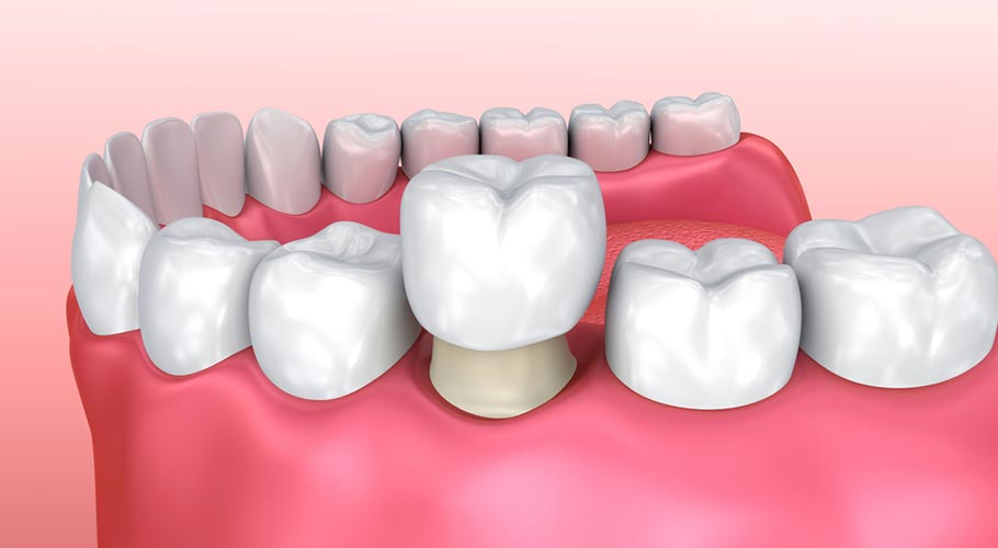 Bọc răng sứ là một phương pháp thẩm mỹ phổ biến giúp cải thiện hình dạng của răng