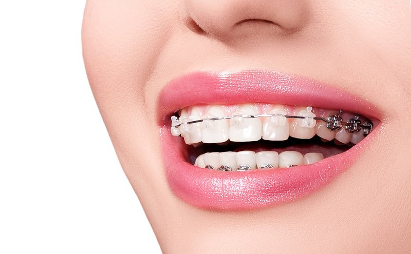 Niềng răng thẩm mỹ là một phương pháp phổ biến được sử dụng