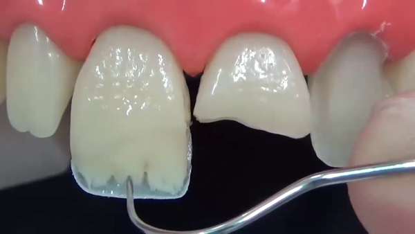 Dán mảnh răng bị vỡ lại