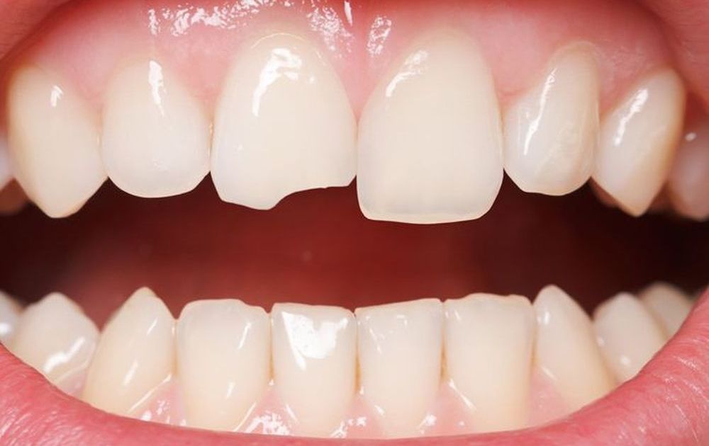 Hậu quả khó lường của việc răng cửa bị mẻ