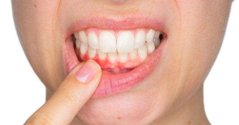 Các chứng bệnh về răng miệng như sâu răng, viêm lợi, viêm nướu hoặc viêm tuyến nước bọt đều có thể góp phần gây nên đắng miệng