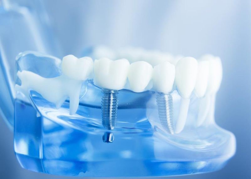 Lợi ích của việc trồng răng Implant hiện nay