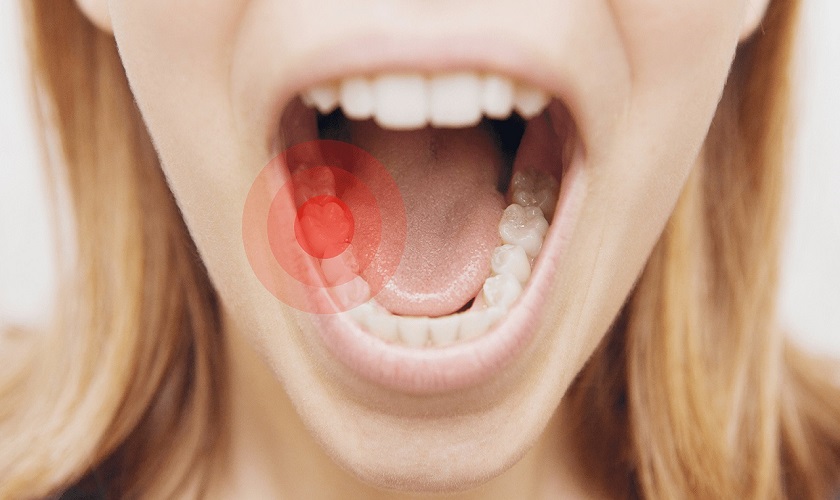 Cách làm giảm đau hiệu quả sau khi trồng răng implant