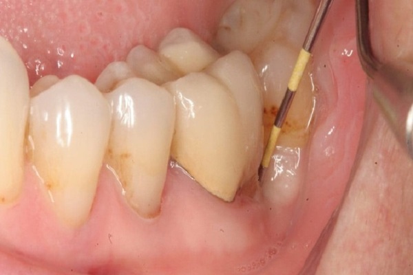 Các bệnh phổ biến thường gặp ở chân răng