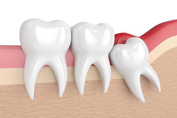 Một số biện pháp giúp hạn chế nguy hiểm khi nhổ răng khôn