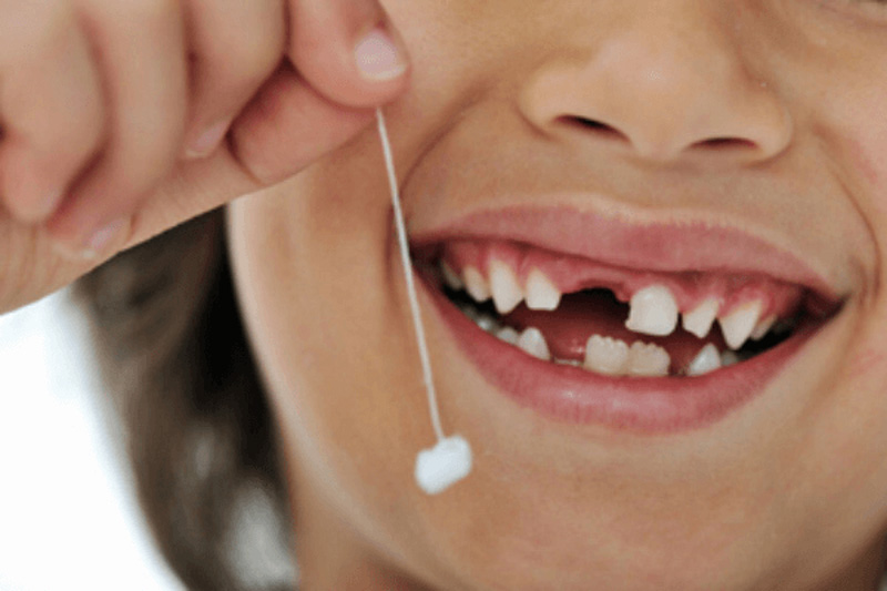 Nhổ răng bằng chỉ là một phương pháp truyền thống và được coi là an toàn