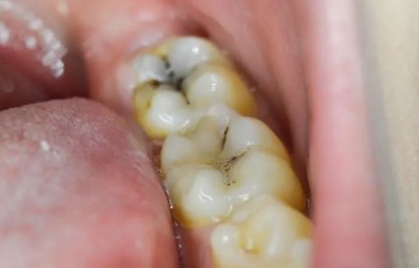 Những ai nên sử dụng cây lá lấu chữa sâu răng