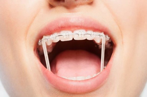 Nuốt dây thun niềng răng có sao không?