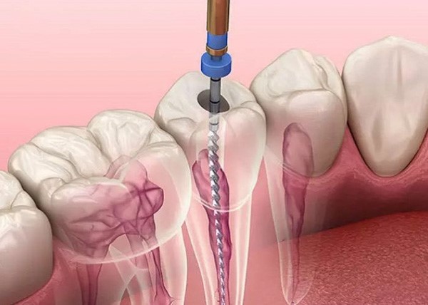 Trám răng lấy tủy là gì?