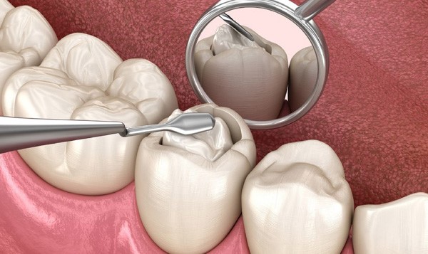 Tại sao phải trám những chiếc răng đã lấy tủy?