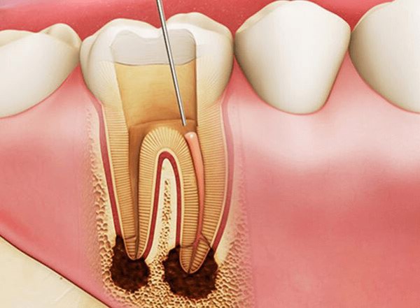 Có bắt buộc phải lấy tủy mỗi khi trám răng không?