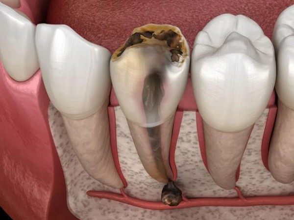Trám răng lấy tủy giá bao nhiêu? Tình trạng răng bị ảnh hưởng