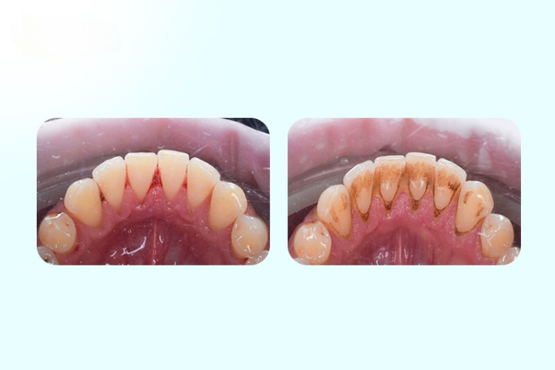 Cao răng từ cấp độ 1 đến 4