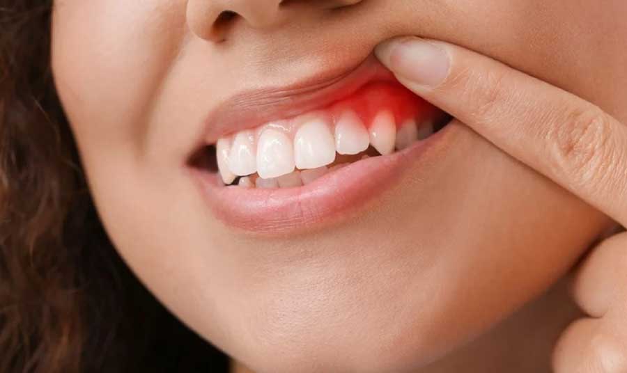 Bị viêm nướu